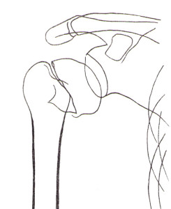 Перелом анатомической шейки кости