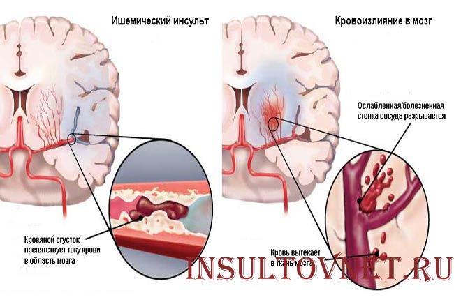 Ковид инсульт. Геморроидальное кровоизлияние в мозг. Кровоизлияние при инсульте.