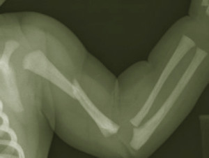 Ренгенснимок перелом плечевой кости