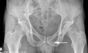 Рентгенография - самый достоверный способ определения переломов