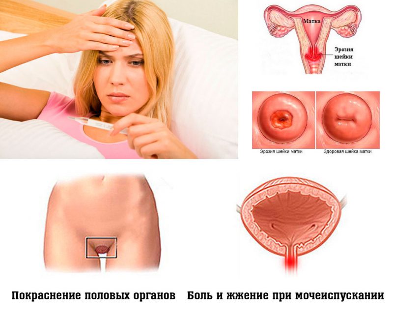 Проявления хламидиоза у женщин
