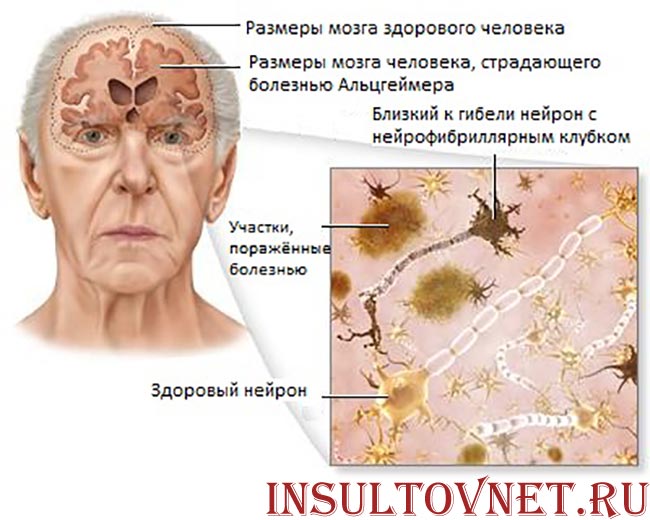 мозг при Альцгеймере