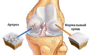 Симптомы артроза коленного сустава