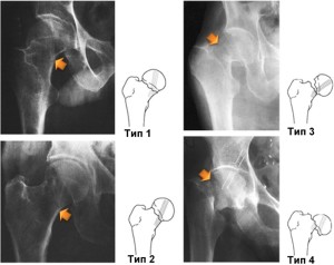 Рентгенограммы различных вариантов переломов