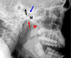 Рентген при вывихе челюсти