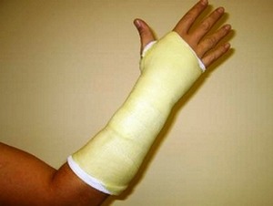 Гипсовая повязка при переломе руки со смещением