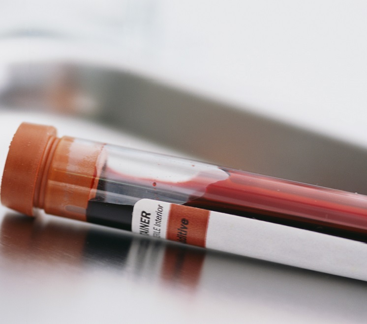 Дополнительный анализ крови на иммуноглобулин типа Ig-E