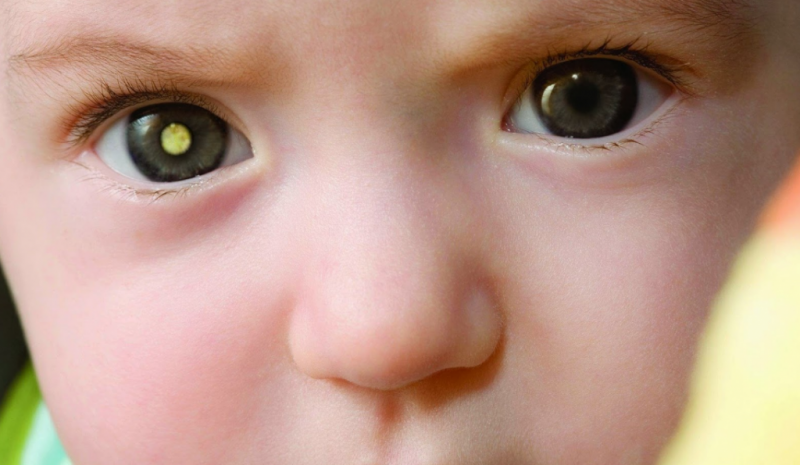 заболевание сетчатки глаз у детей