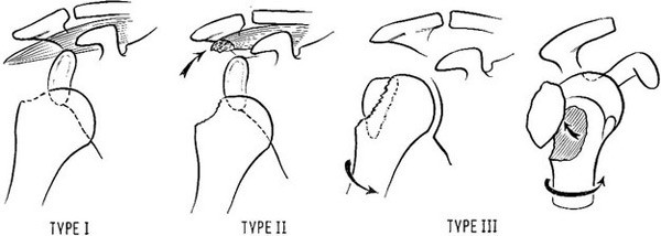 Типы переломов бугорка плечевой кости