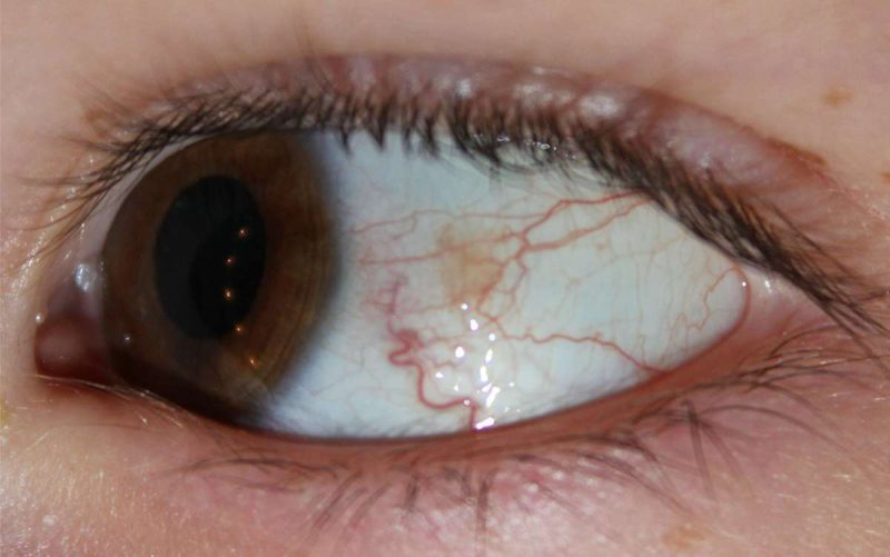 Хламидиоз глаз