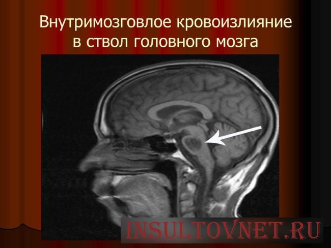 Инсульт ствола головного мозга
