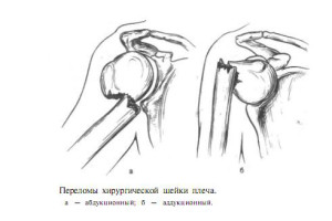 Аддукционный и абдукционный переломы шейки плеча