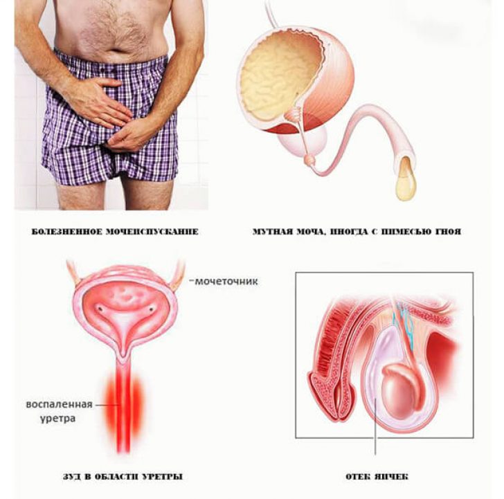 Хламидиоз у мужчин симптомы