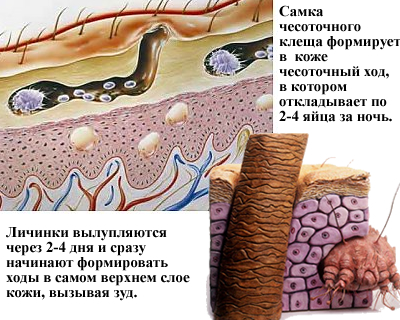 чесоточный клещ