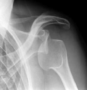 Рентген вывиха плеча