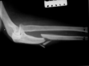 Рентген перелома локтевой кости