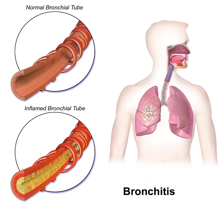 Бронхит - осложнение после противогельминтной терапии