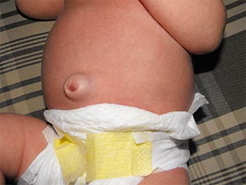 Лечение пупочной грыжи у детей без вмешательства хирурга
