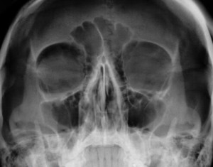 Рентгенологическое исследование черепа