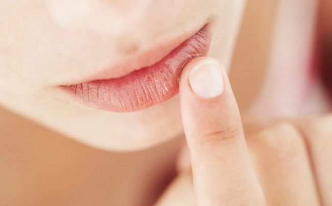 Хейлит на губах: методы лечения и мази