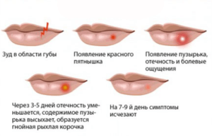 Симптомы герпеса на губах