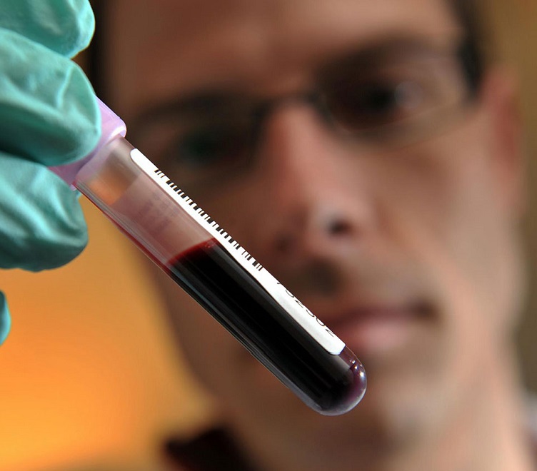 Анализ крови на антитела - наиболее достоверный вариант диагностики лямблиоза