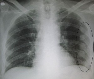 Рентгеновский снимок перелома грудины