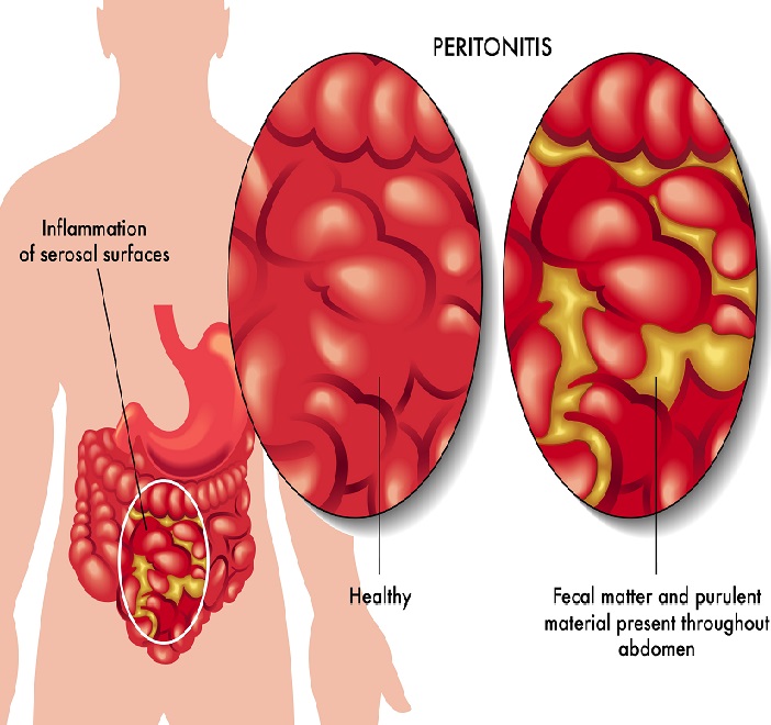 Перитонит - осложение описторхоза