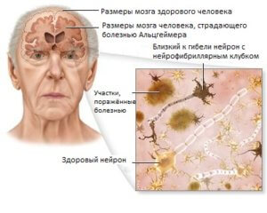 Болезнь альцгеймера симптомы