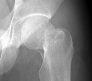 Рентгеновский снимок чрезвертельного перелома бедренной кости