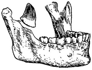 Перелом венечного отростка нижней челюсти