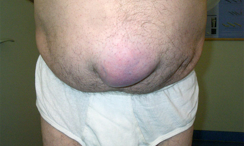 Hernia umbilical barriga hinchada