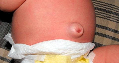Как использовать пластырь от пупочной грыжи для новорожденных?