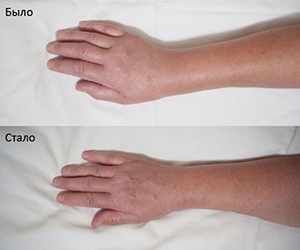 Результаты восстановления руки