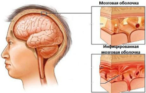 При открытом переломе, в спинномозговую жидкость могут проникнуть бактерии и вызвать менингит
