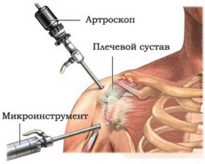 Артроскопия — метод диагностики при привычном вывихе