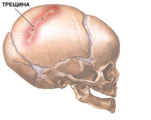 Ушиб и трещина черепа thumbnail