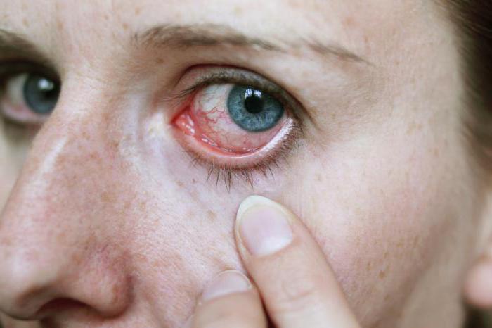 Симптомы появления глистов в глазах