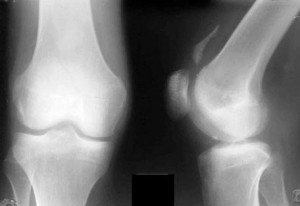 Рентгеновский снимок перелома коленного сустава