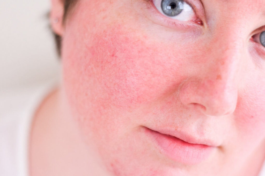 Купероз на лице: лечение домашними и другими средствами