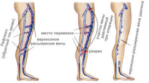 Варикозное расширение вен на ноге человека