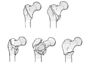 Классификация чрезвертельных переломов бедренной кости