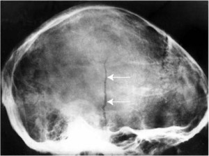 Рентген при линейном переломе теменной кости черепа