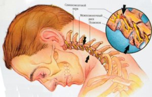 Схема остеохондроза шеи