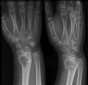 Рентген при переломе лучевой кости