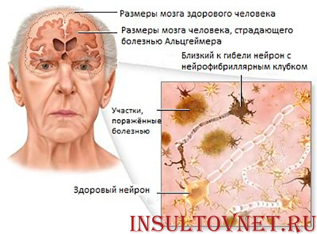 нейроны при болезни Альцгеймера